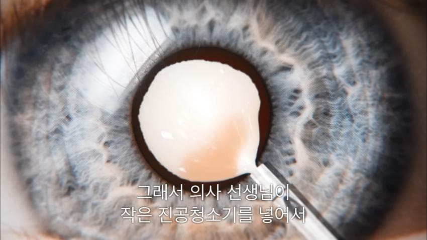 시각장애인 천명 수술시켜 준 미스터 비스트ㄷㄷ
