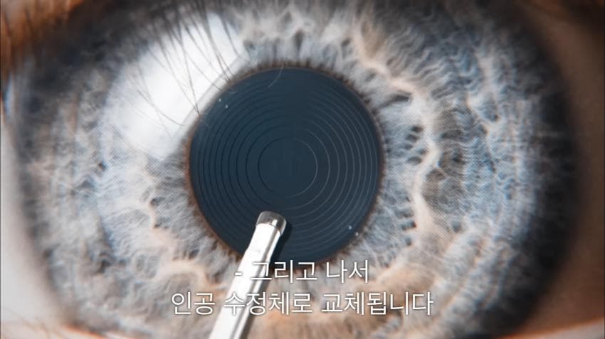 시각장애인 천명 수술시켜 준 미스터 비스트ㄷㄷ