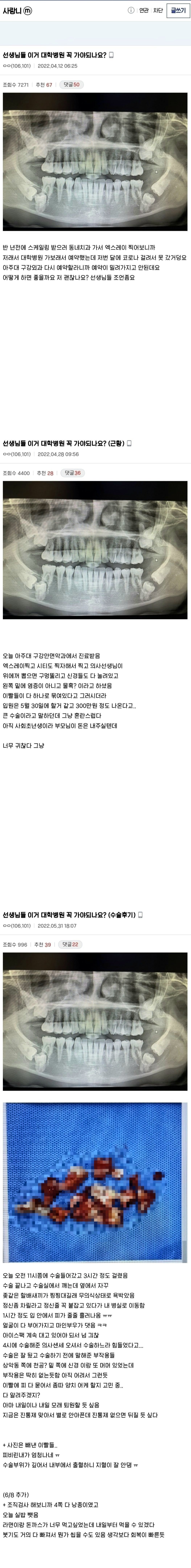 (혐) 디씨 사랑니갤 수술 레전드