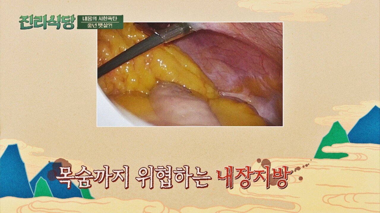약혐) 몸에 내장지방 존나게 쌓였을때 모습