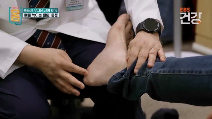 30대 통풍 환자의 발상태.ㄷㄷ