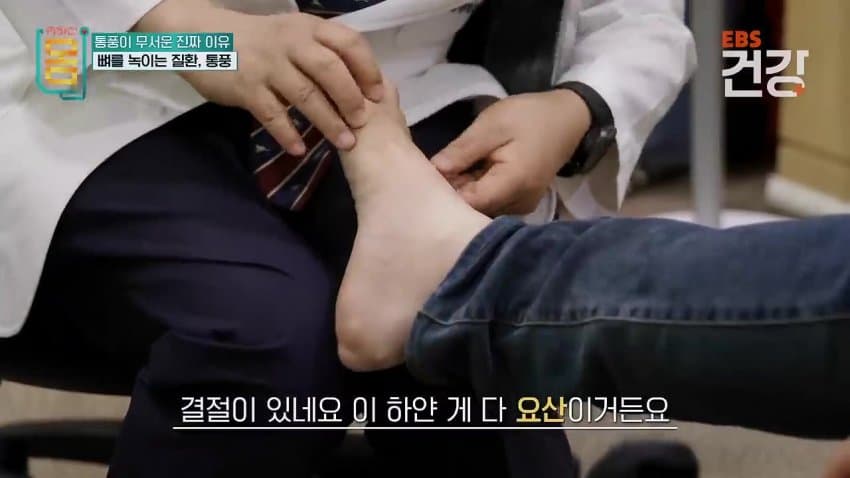 30대 통풍 환자의 발상태.ㄷㄷ