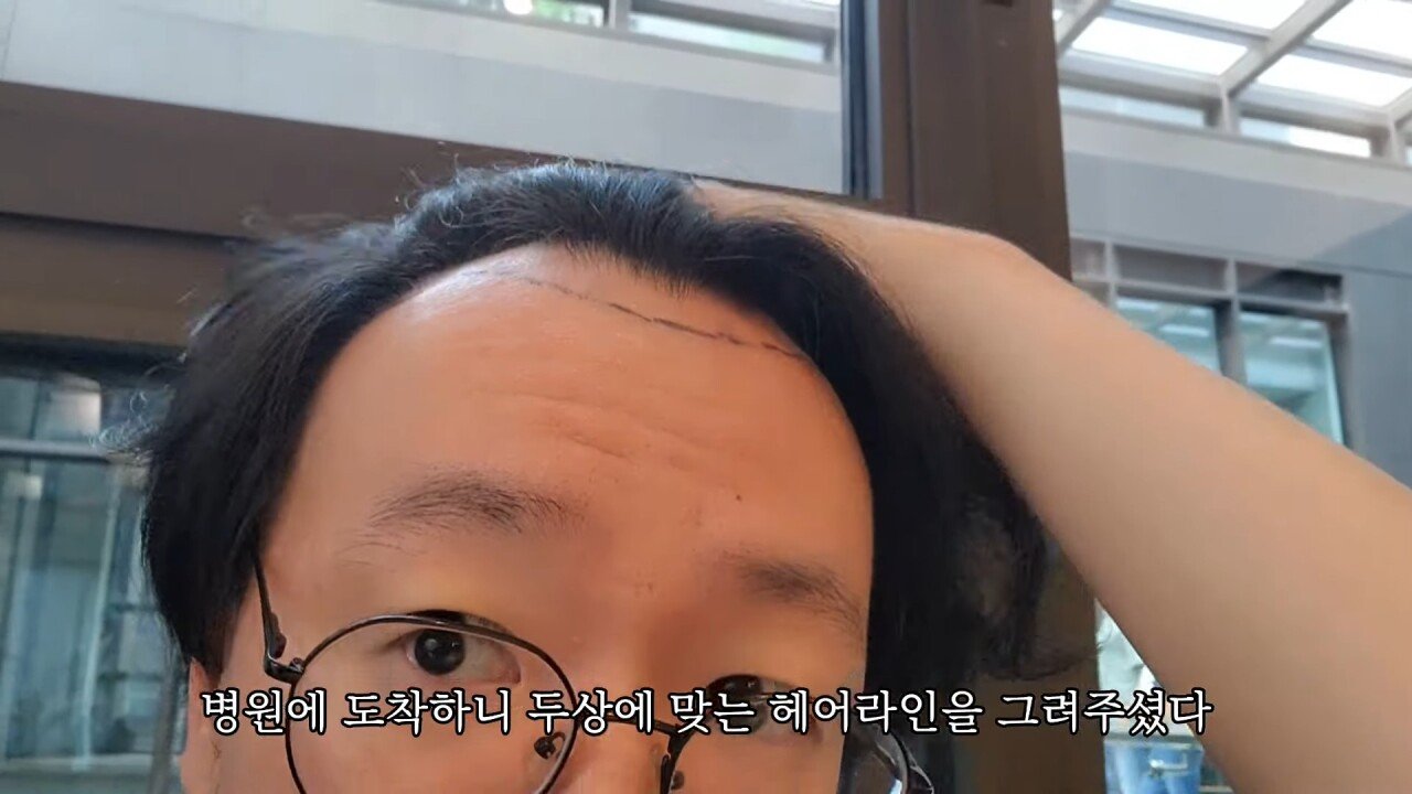 터키에 모발이식하러 갔다가 삭발만 하고 온 유튜버.
