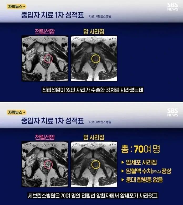 중입자 암치료 기계 성능 근황
