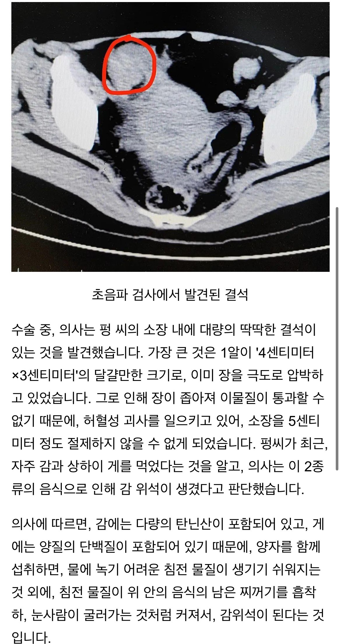 '감‘과 ’꽃게‘를 먹고 급성 장폐색으로 죽을뻔한 중국인