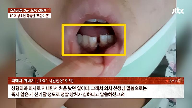 주한 미군 주먹에 10대 학생 '턱뼈' 부 서져