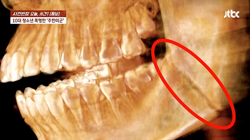 주한 미군 주먹에 10대 학생 '턱뼈' 부 서져