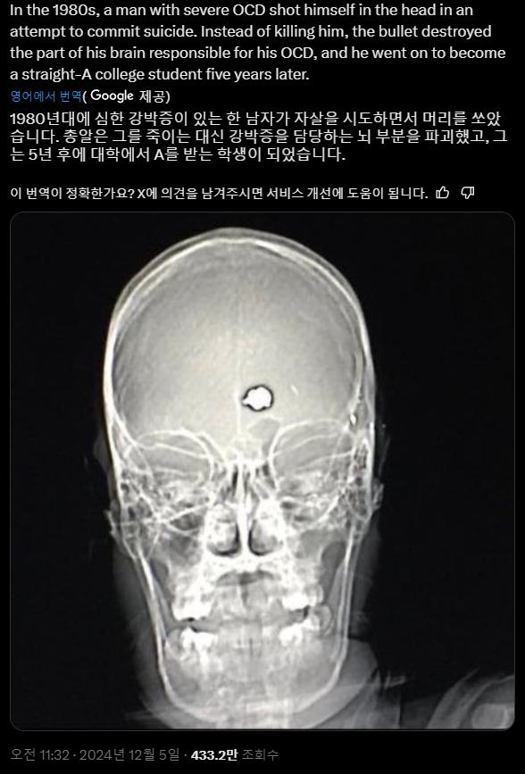 1980년대 셀프 뇌수술