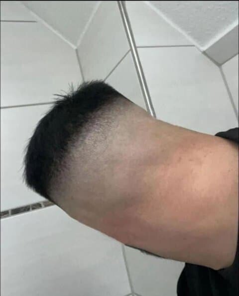 ???: 팔 절단 했는데 털이 자라요...