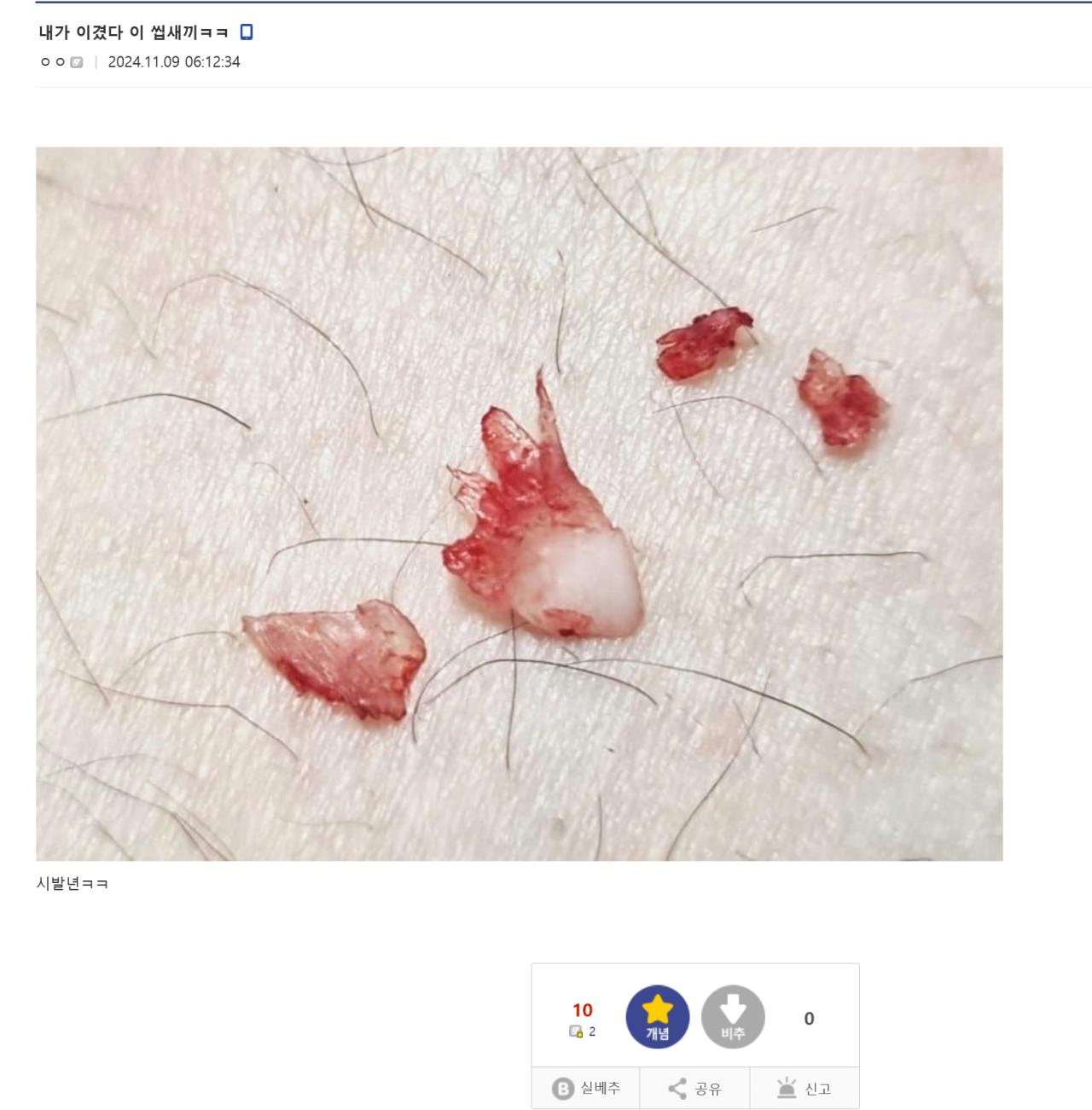 혐)내성발톱 갤러리 레전드