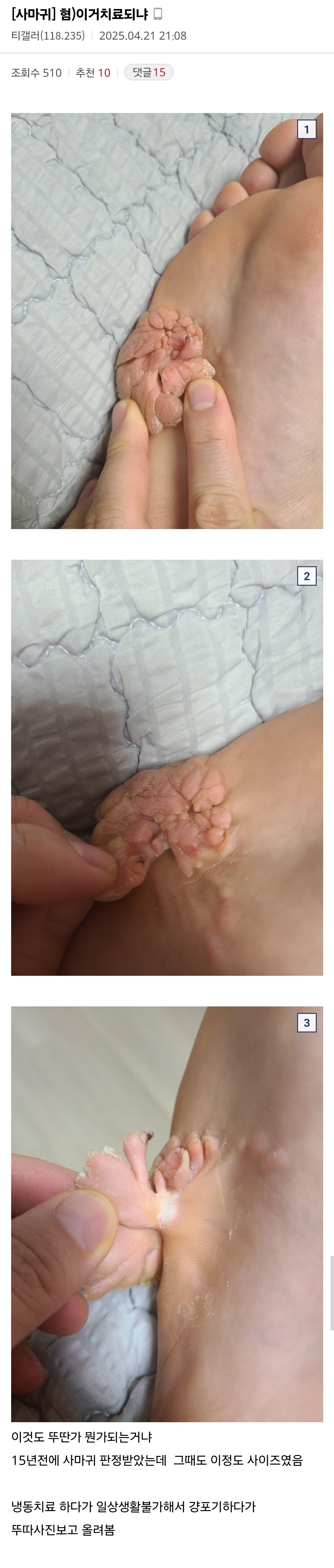 혐주의) 티눈갤에 올라온 역대급 사마귀