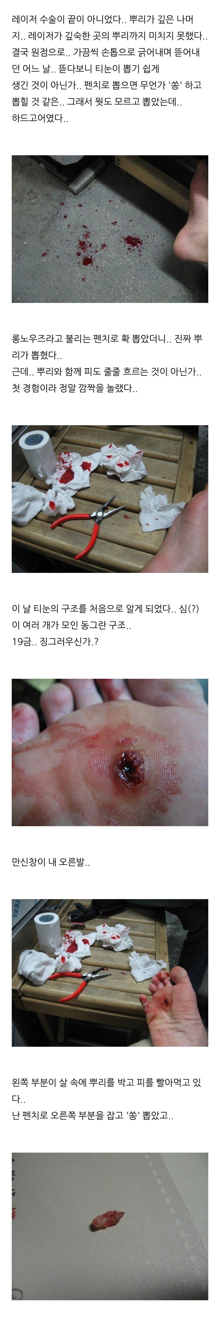 극혐주의) 스압) 사마귀 완치한 사람의 과정