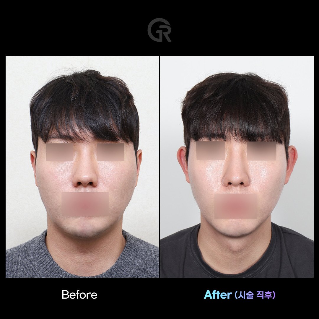 요즘 유행하는 귀 필러 시술 ㄷㄷ