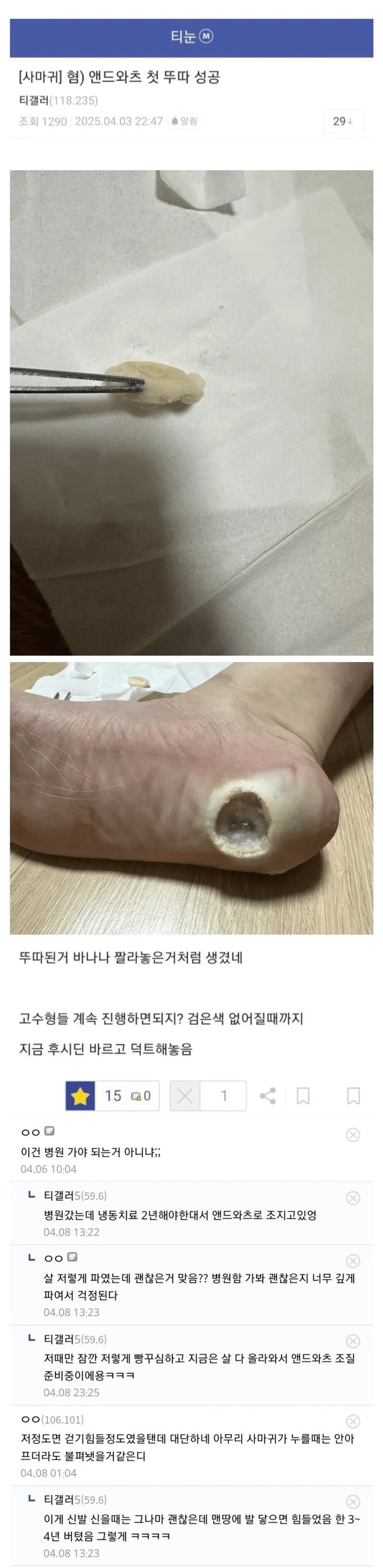 혐주의) 발에 구멍난 티눈갤