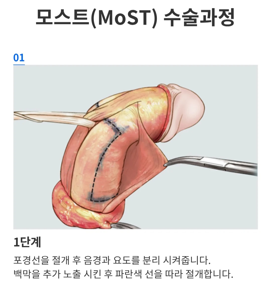 발기부전일때 최후의 선택지