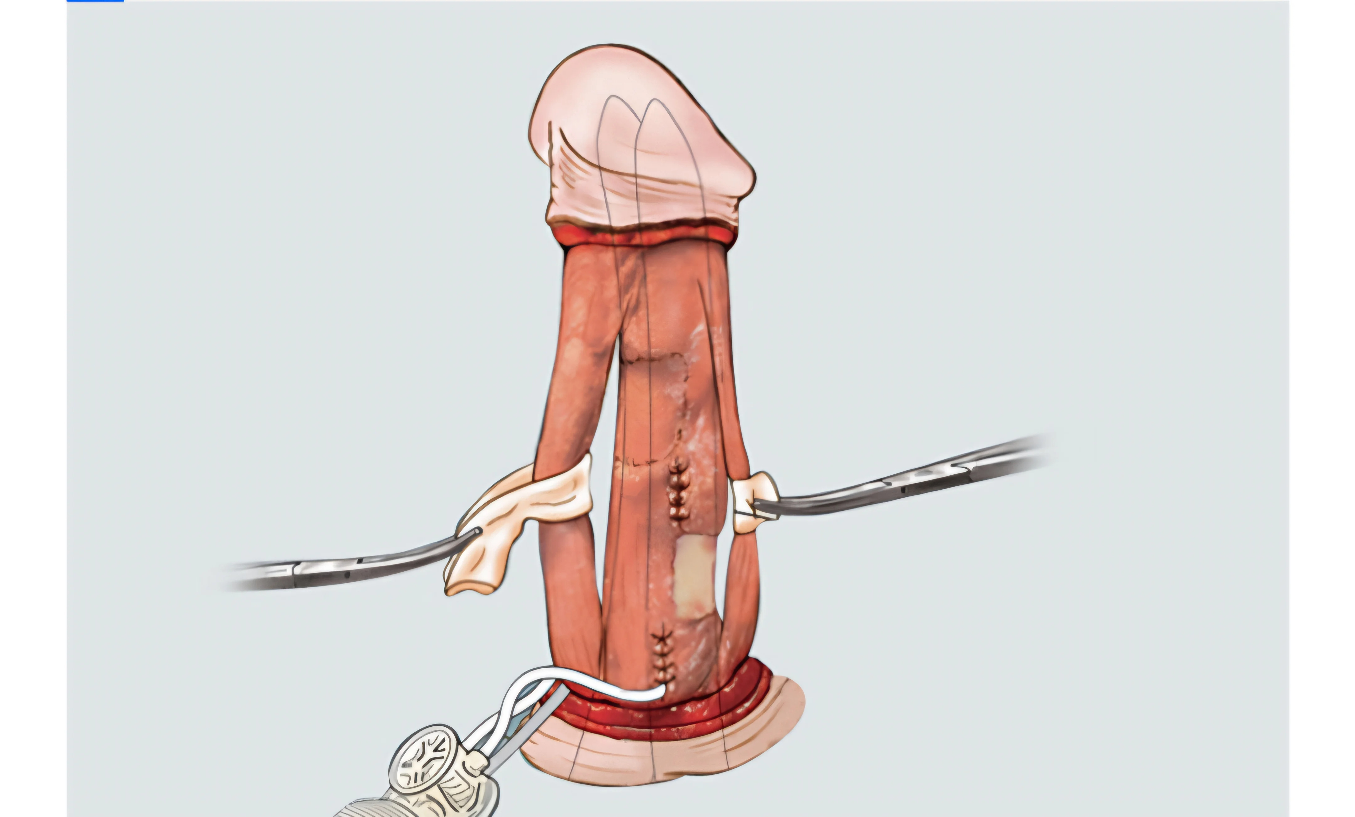 발기부전일때 최후의 선택지