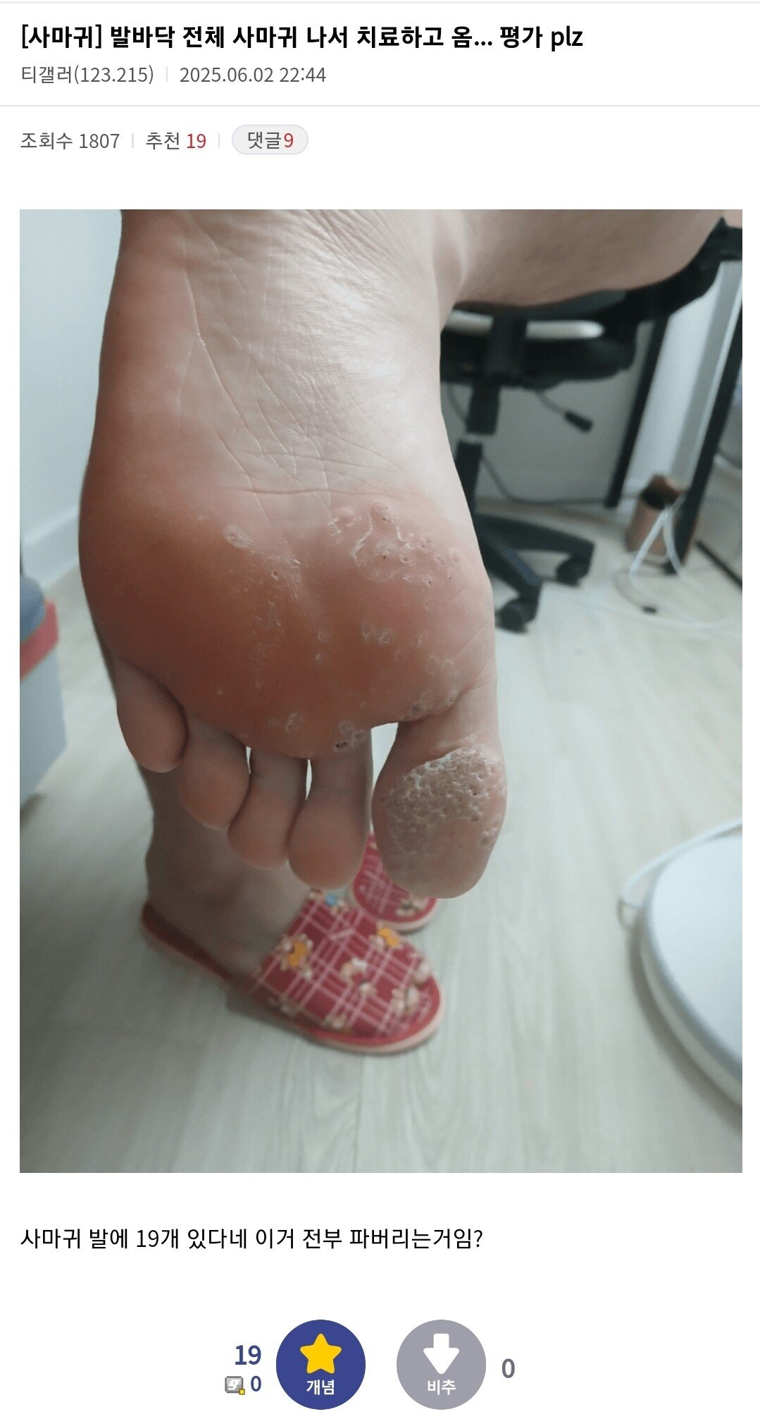 혐)티눈 갤러리 근황