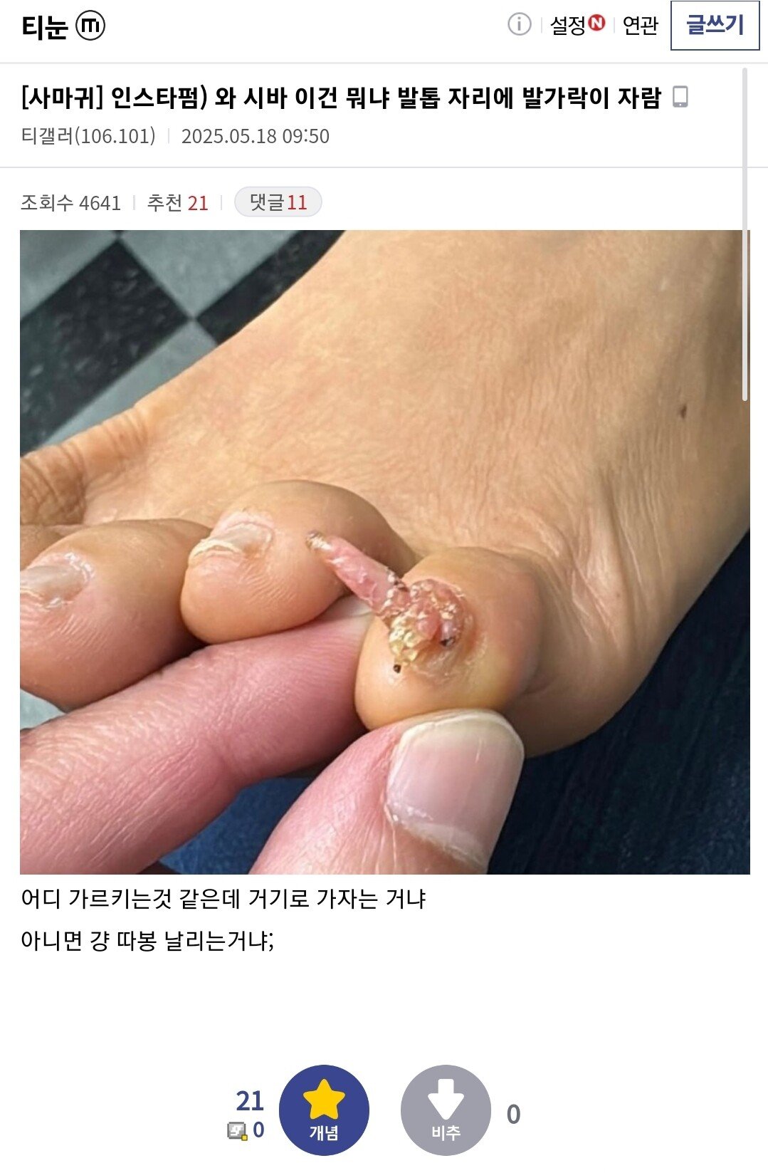 혐)티눈 갤러리 근황