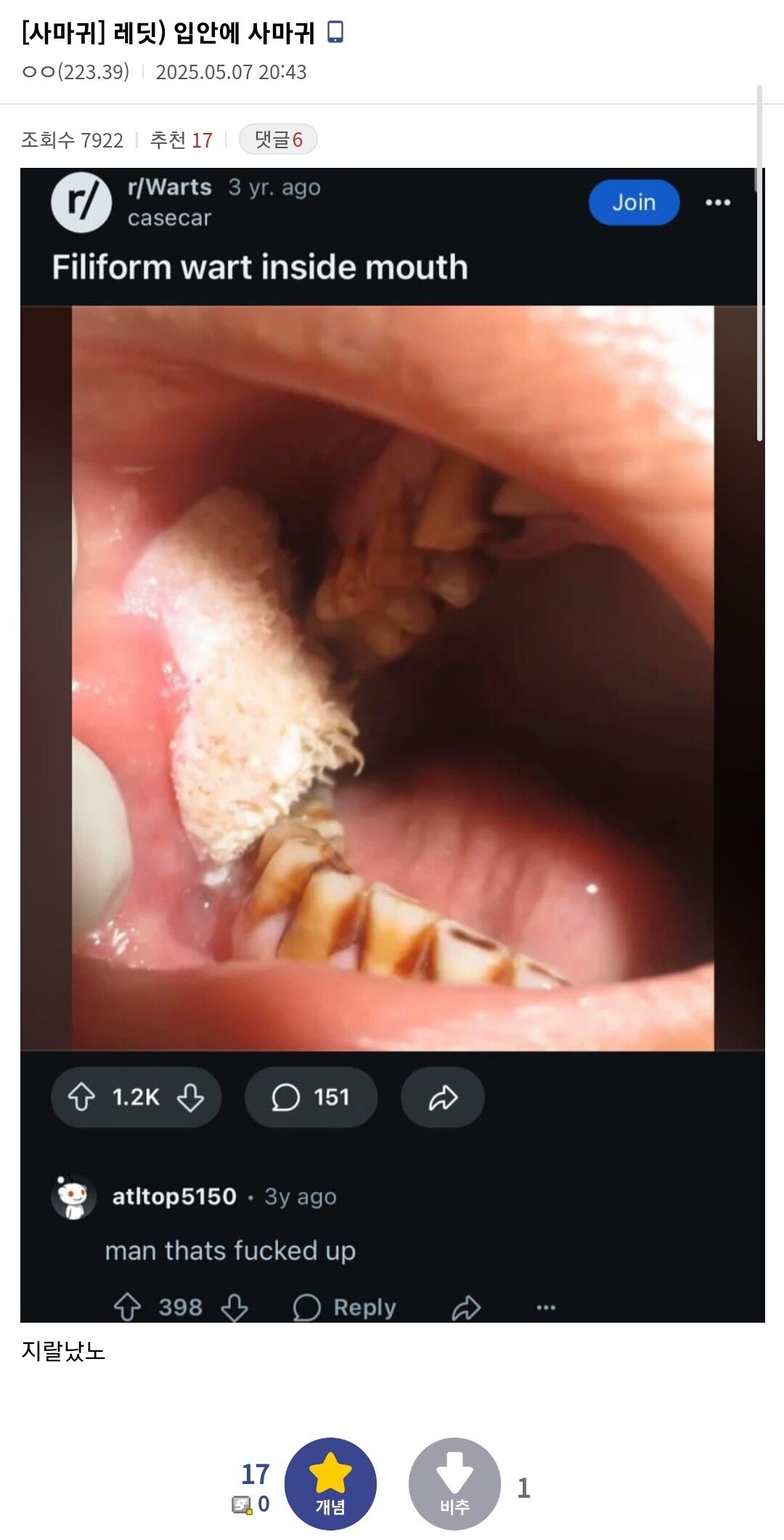 혐)티눈 갤러리 근황