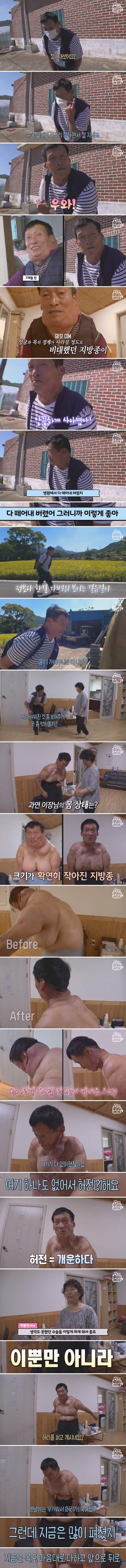 29년 만에 7kg 지방종을 없앤 남자 ㄷㄷㄷ