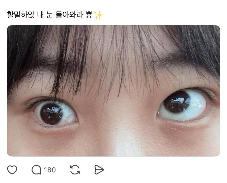 (충격주의) 현재 난리 난 눈밑 지방제거술 부작용