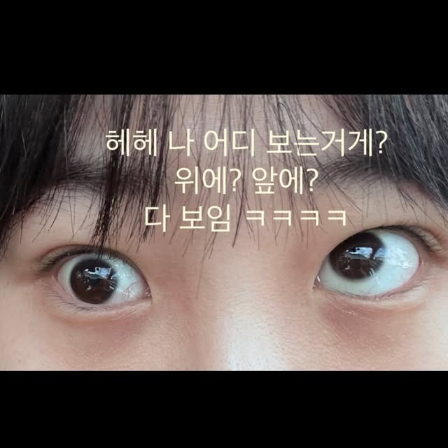 놀람주의) 눈밑지방 제거수술하고 사시 된 환자....병원 입장문