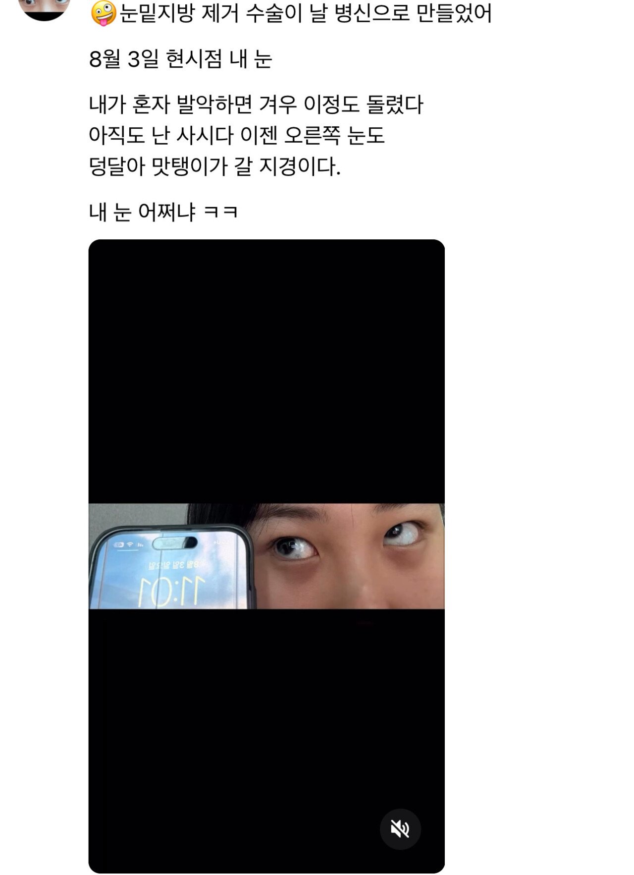 놀람주의) 눈밑지방 제거수술하고 사시 된 환자....병원 입장문