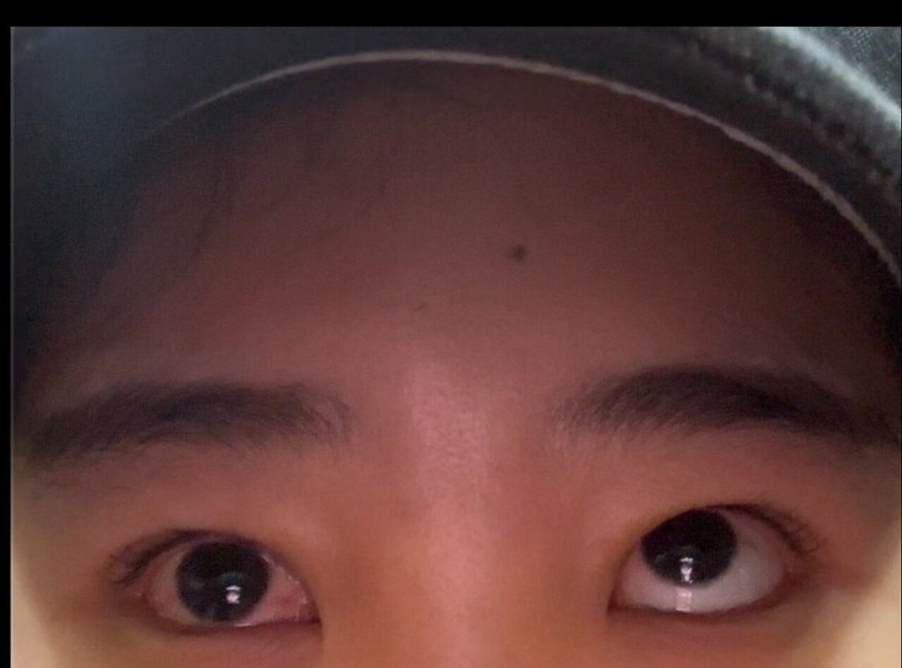 놀람주의) 눈밑지방 제거수술하고 사시 된 환자....병원 입장문