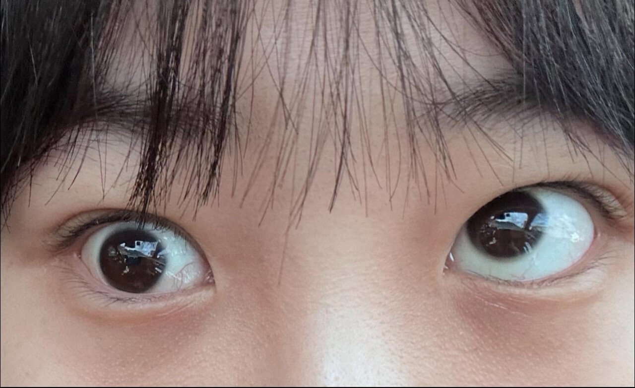 놀람주의) 눈밑지방 제거수술하고 사시 된 환자....병원 입장문