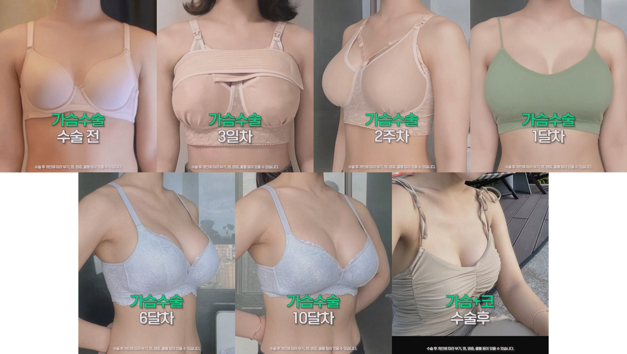 ㅇㅎ) 예전보다 많이 대중화 된 거 같은 성형수술 분야