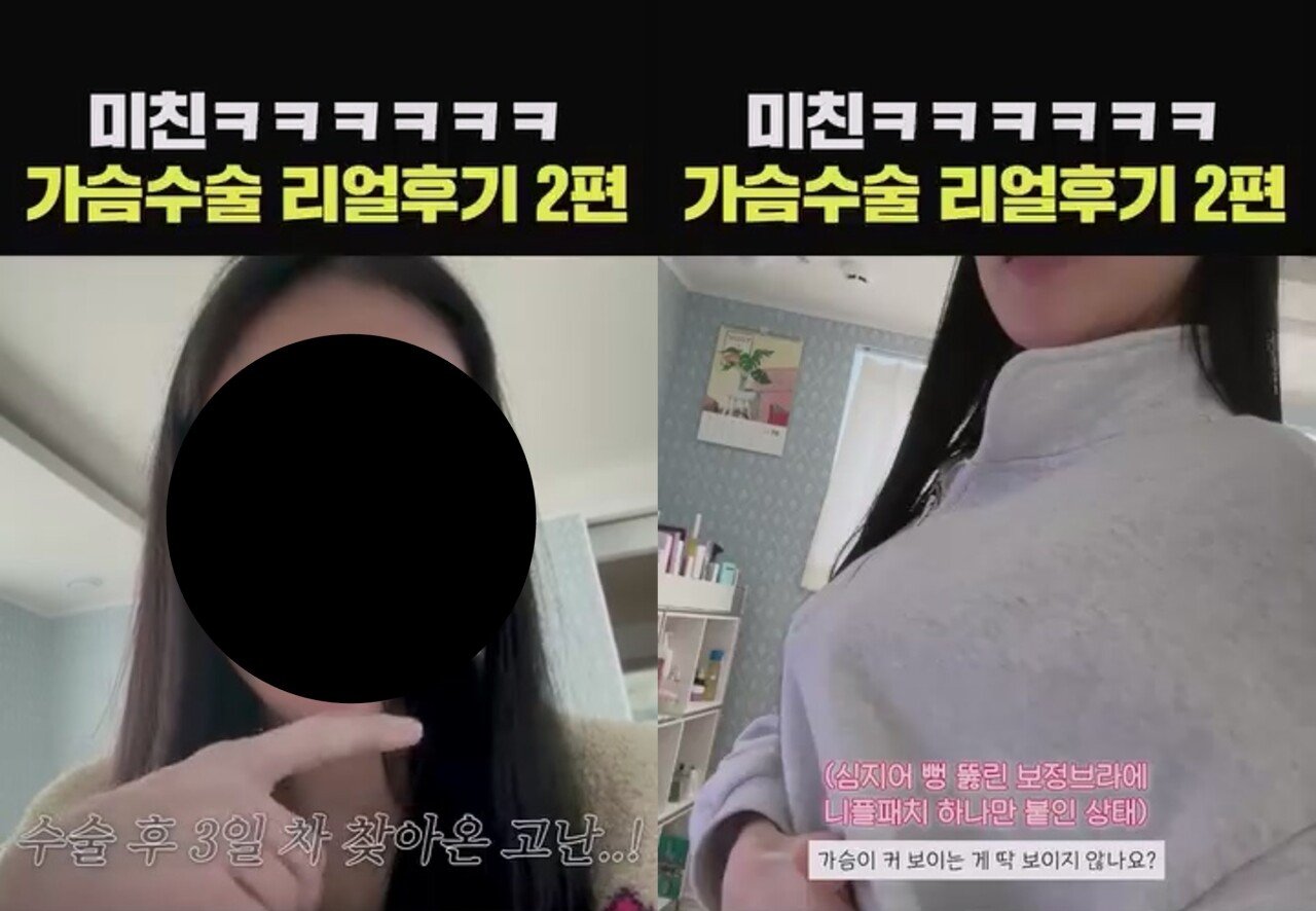 ㅇㅎ) 예전보다 많이 대중화 된 거 같은 성형수술 분야