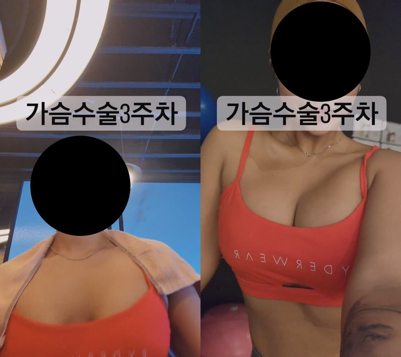 ㅇㅎ) 예전보다 많이 대중화 된 거 같은 성형수술 분야