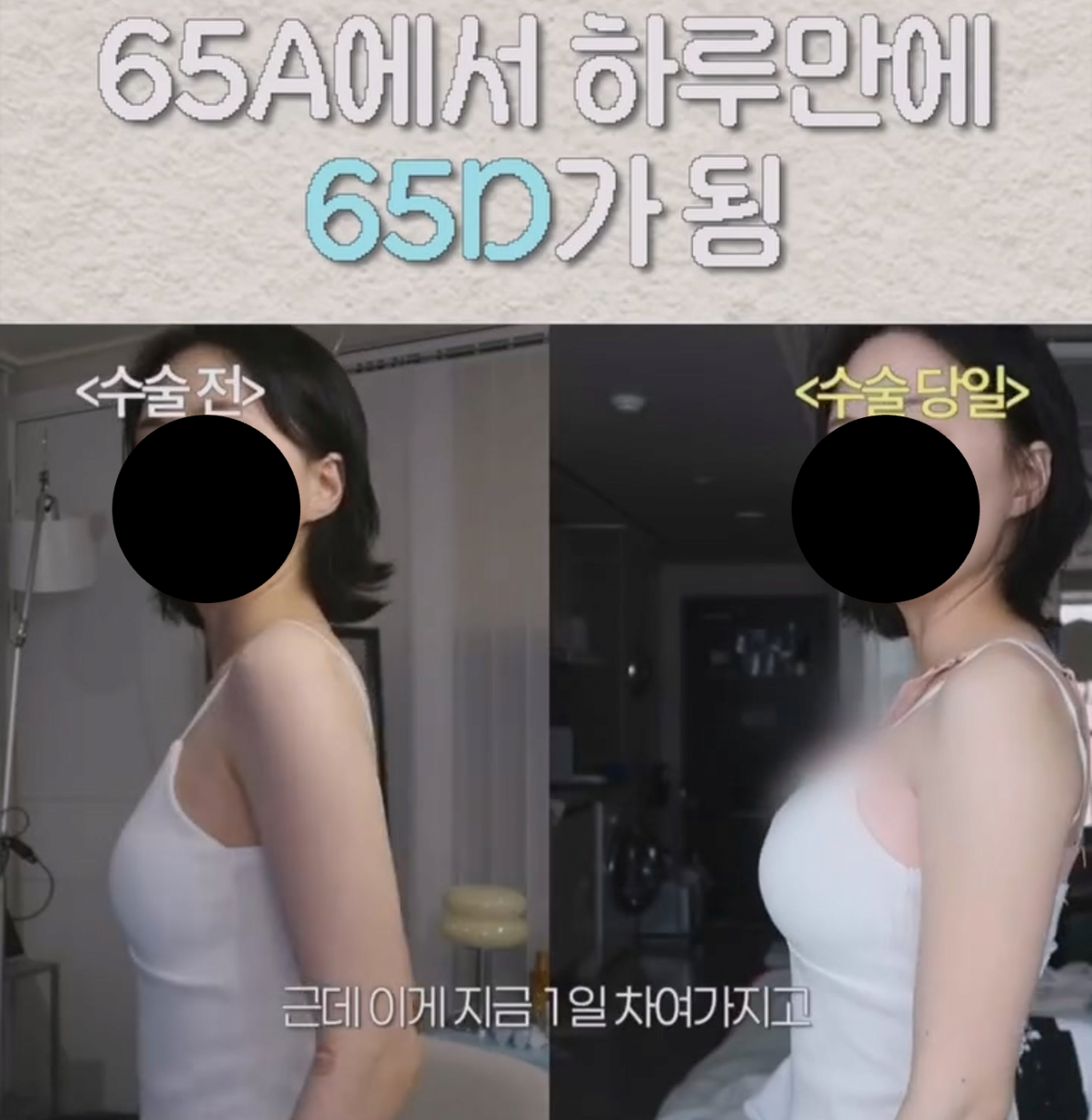 ㅇㅎ) 예전보다 많이 대중화 된 거 같은 성형수술 분야