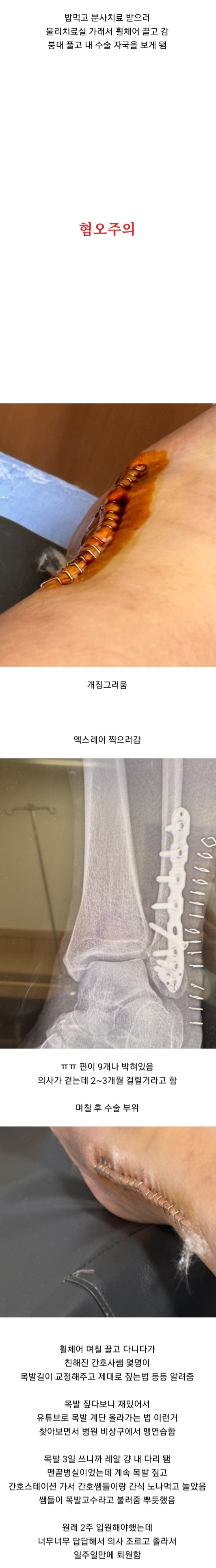 발목 부러졌는데 하나도 안아프다는 여자의 11개월 뒤 ㄷㄷ