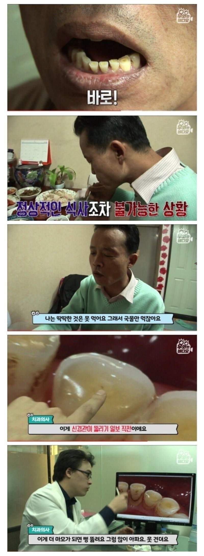20년 이갈이 한 사람의 치아 상태
